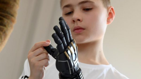 Oxandre je bioničku ruku Open Bionicsa dobila zahvaljujući podršci francuskog zdravstvenog osiguranja