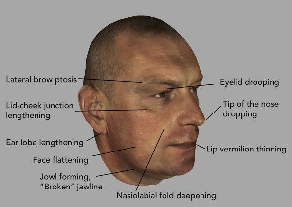 Primjer skeniranja površine lica s označenim značajkama vezanim za starenje