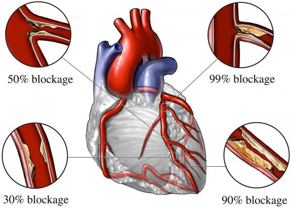 Koronarna arterijska bolest