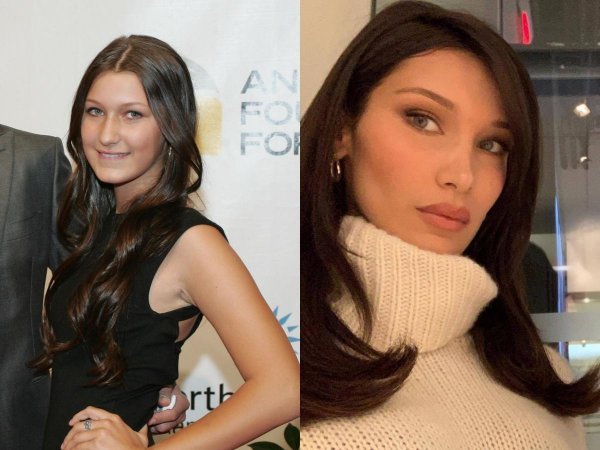 Bella Hadid prije i poslije zahvata