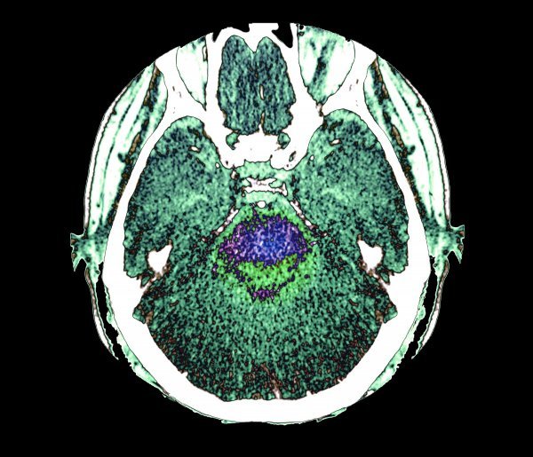 Skeniranja sugeriraju da su upale mozga nastale reakcijom imunološkog sustava oboljelih od Covida-19