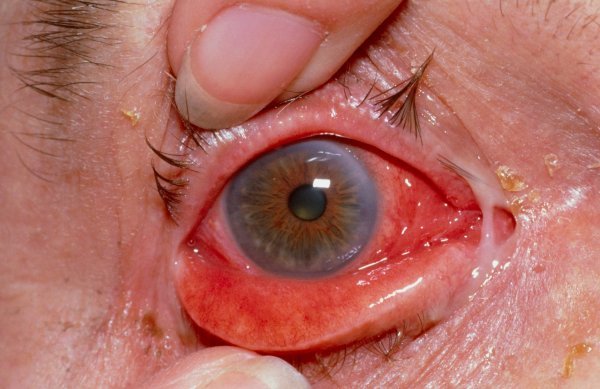 Konjuktivitis ili ružičasto oko neobičan je simptom Covida, a kod osoba koje pate od cjelogodišnjeg alergijskog rinitisa i/ili konjuktivitisa može ga potaknuti i sezonska alergija