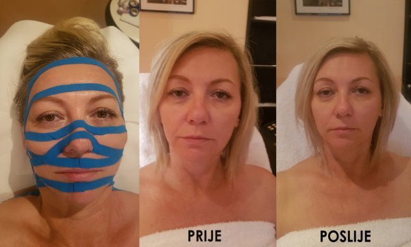 Kineziološke trake se među ostalim primjenjuju za mladenačke probleme jer omogućuju bolji rad limfe, a tako dolazi do izbacivanja toksina i suvišnih tvari te smanjenja upalnog procesa