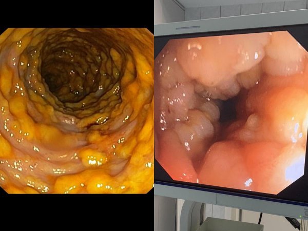 Endoskopski (kolonoskopski) nalaz prije (lijevo) i poslije (desno) FMT liječenja pseudomembranoznog kolitisa u pacijentice KB-a Merkur