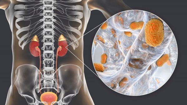 Akutni pijelonefritis izazvan bakterijama Acinetobacter