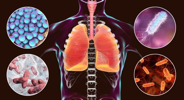 Bakterije koje uzrokuju bolničku upalu pluća: Staphylococcus aureus (gore lijevo), Pseudomonas aeruginosa (gore desno), Klebsiella pneumoniae (dolje lijevo) i Escherichia coli (dolje desno)