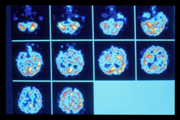PET sken mozga šizofreničara