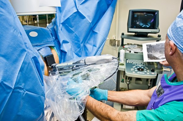 Liječenje raka debelog crijeva - ilustracija