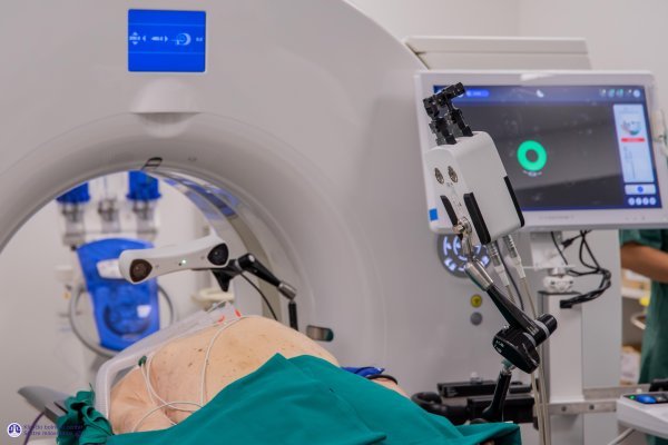 Ablacija i biopsija tumora pomoću robotske ruke u KBC-u Sestre milosrdnice