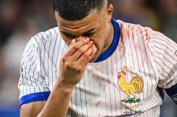 Kylian Mbappe ozljeda, EURO 2024.; 17.6.2024.