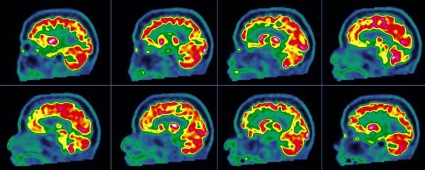 Alzheimerova bolest