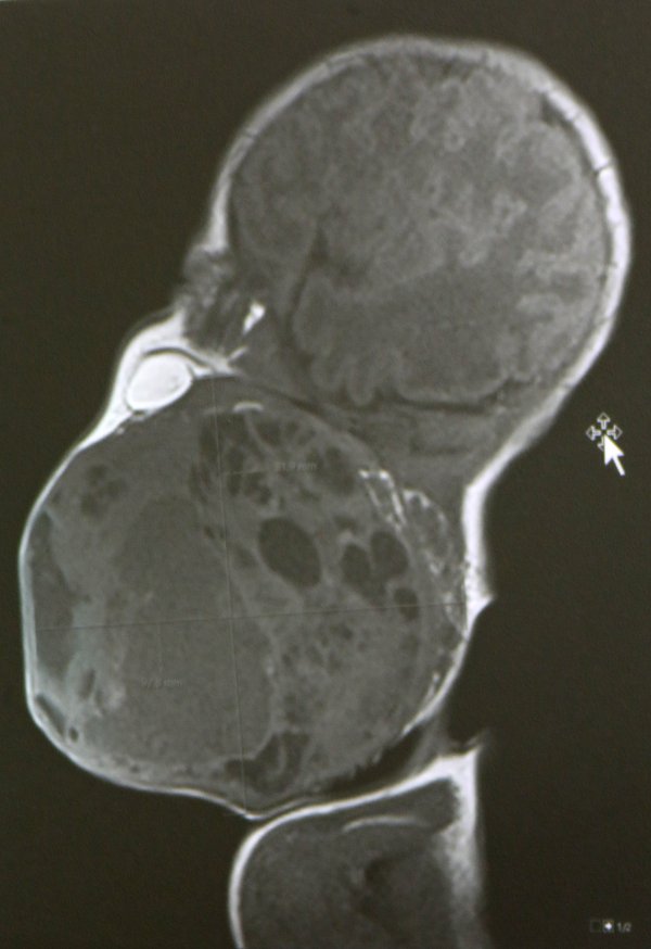 Tumor koji su liječnici odstranili