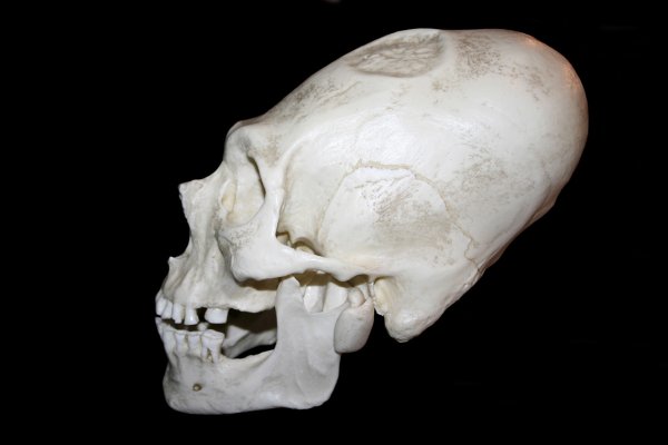 Izduživanje lubanja: Što se krije iza jednog od najbizarnijih običaja u povijesti?