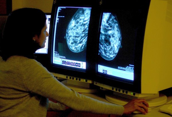 Pet tretmana, jedan tjedan: Radiochirurgia Zagreb ima novu radioterapiju dojke