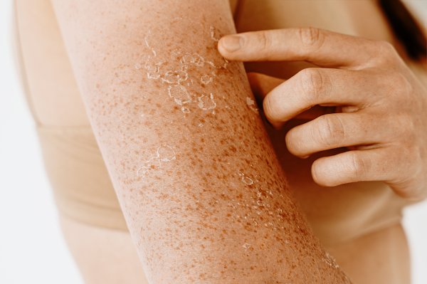 Dermatolozi upozoravaju na čestu pogrešku koja može dodatno nadražiti oštećenu kožu
