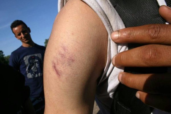 Ozljede koje su dokumentirali volonteri No Name Kitchen