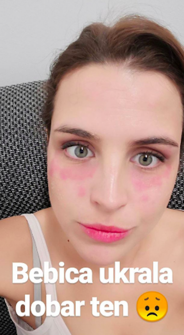 Doris Pinčić Rogoznica s alergijskom reakcijom na licu