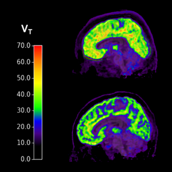 Mozgovi osoba s PTSP-om i suicidalnim mislima (gore) pokazuju više razine mGluR5